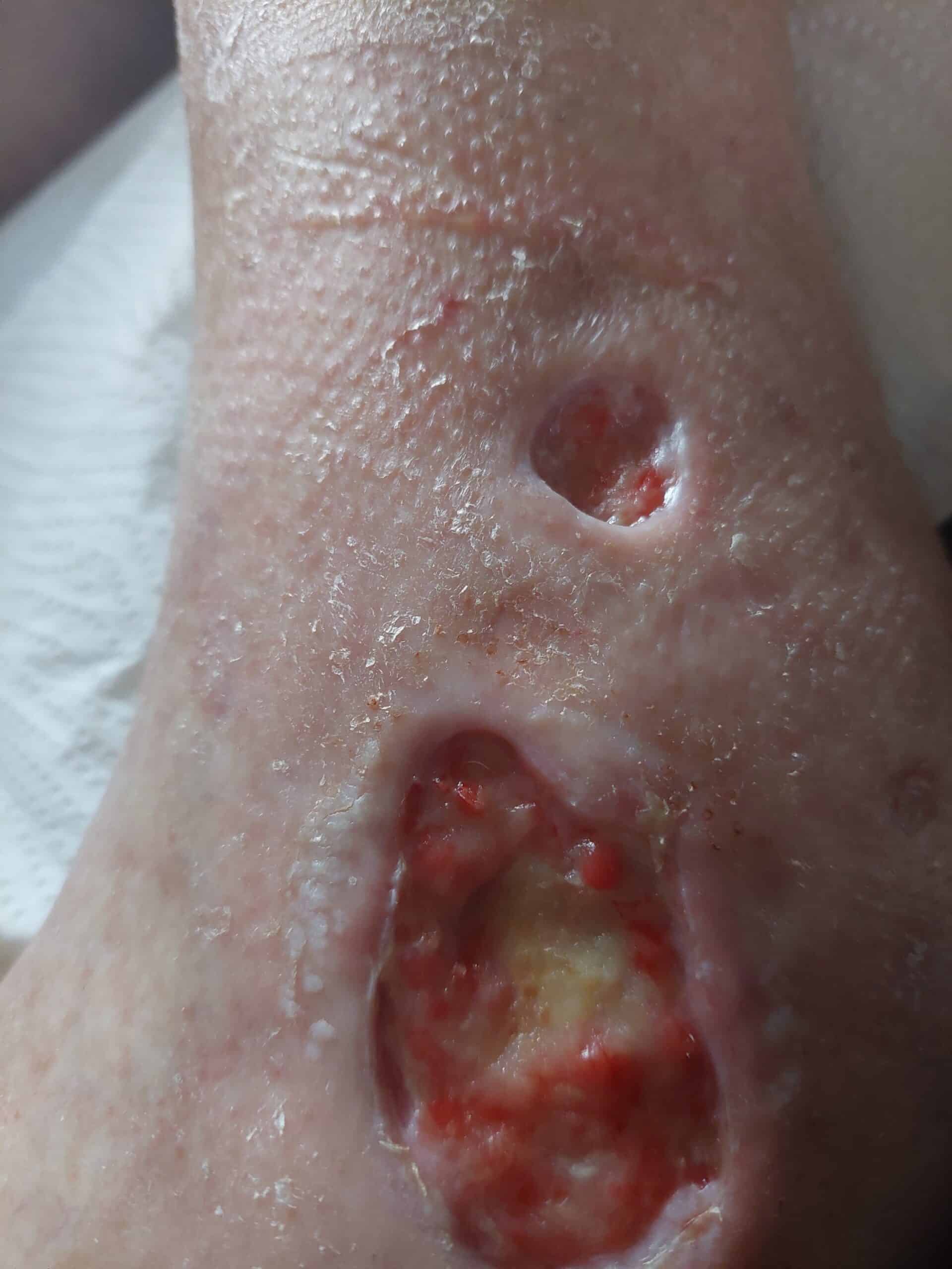 Lyckad sårläkning med Medicinsk Laser 1 Sårläkning 31 Januari 2025