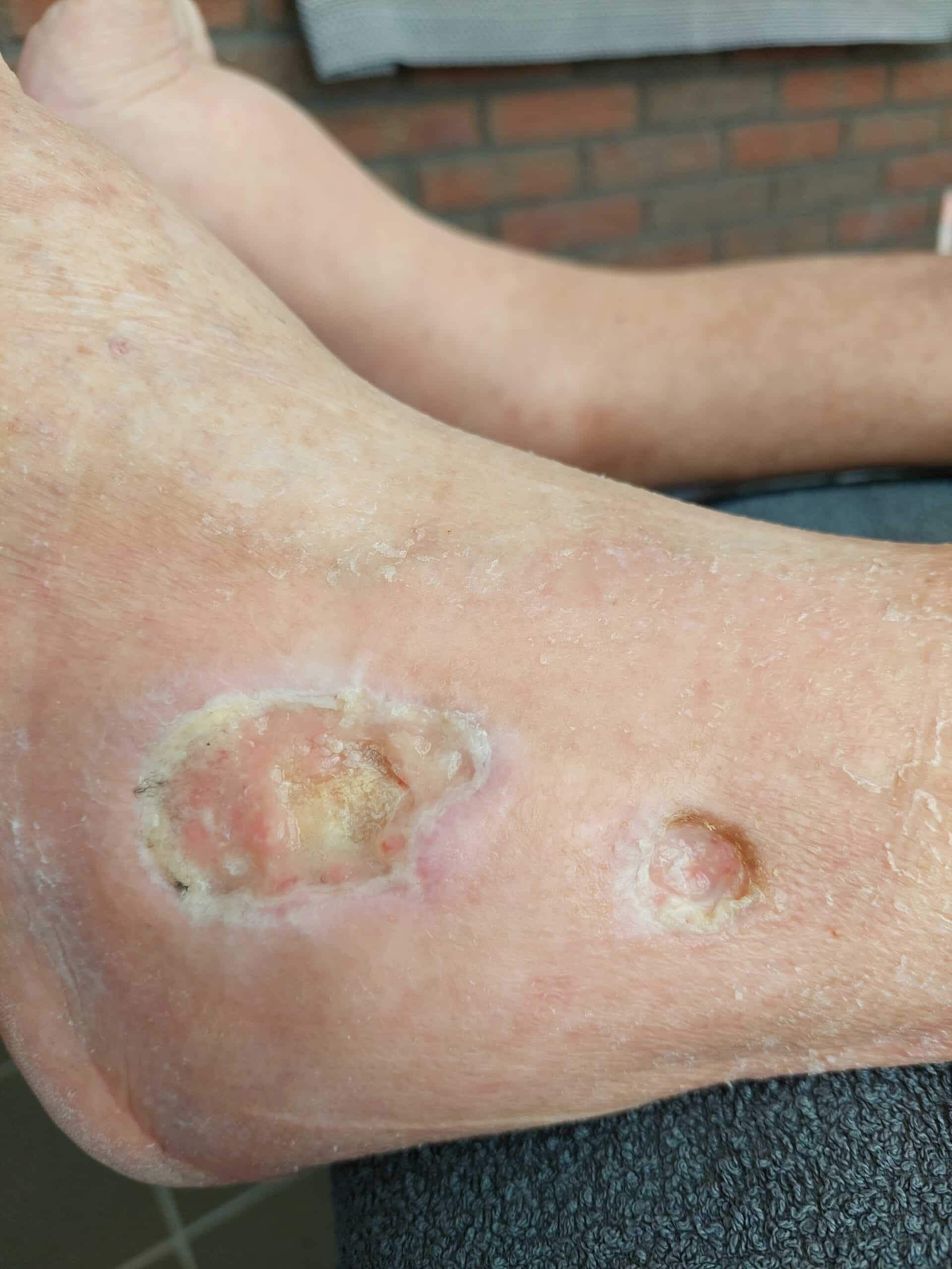 Lyckad sårläkning med Medicinsk Laser 3 Sårläkning 18 februari 2025